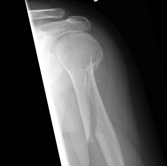 https://upload.wikimedia.org/wikipedia/commons/0/00/Humerus_spiral_fracture.png