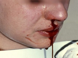 Nosebleed (Epistaxis) picture